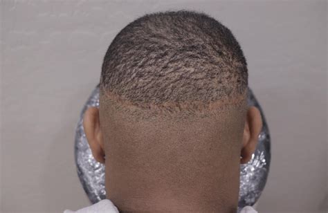 scalp micropigmentation reddit.